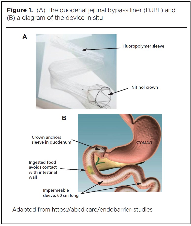 Figure 1. (A) The duodenal jejunal bypass liner (DJBL) and (B) a diagram of the device in situ