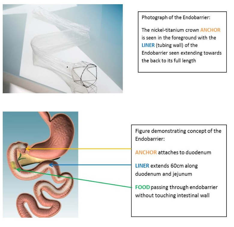 What is EndoBarrier Image